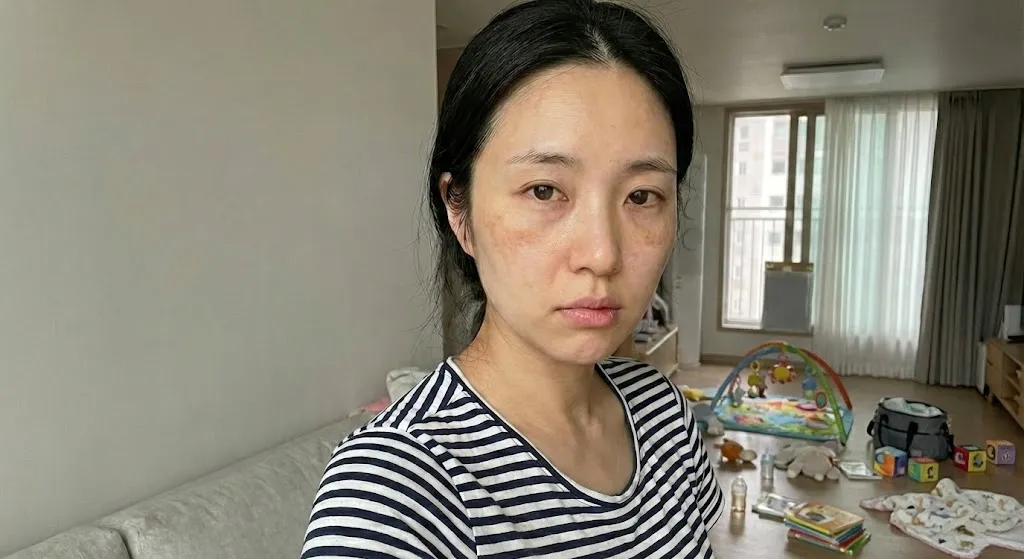 피부노화와 기미